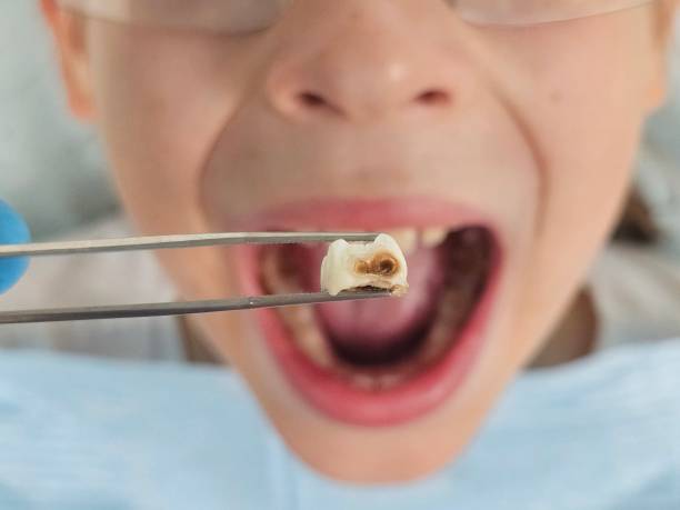 Best Cracked Tooth Emergency Dentist  in Winter Park, FL